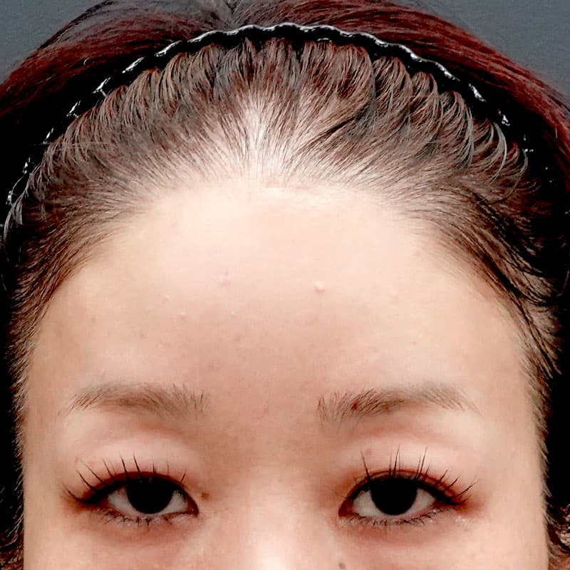 20250828_O37097_tanaka_hyaluronic forehead①After
