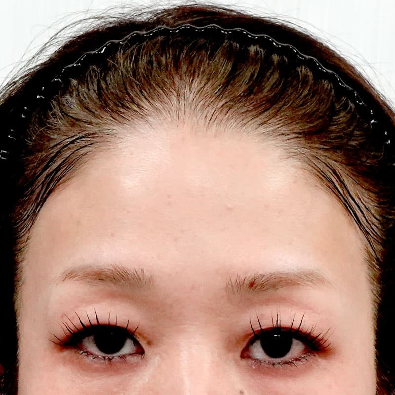 20250828_O37097_tanaka_hyaluronic forehead①Before
