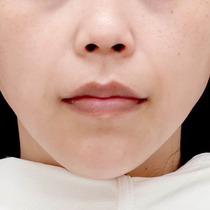 20250831_N115661_tanaka_hyaluronic lips jaw①After