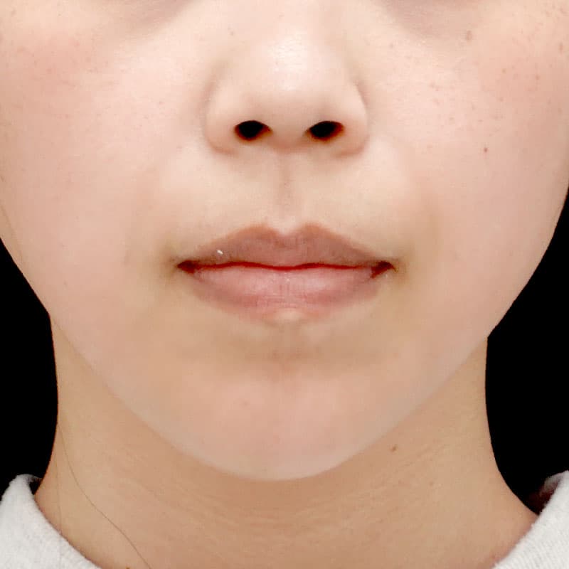 20250831_N115661_tanaka_hyaluronic lips jaw①Before