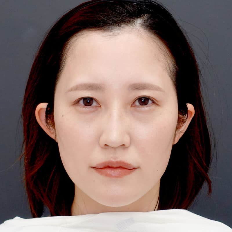 20250831_N133242_tanaka_hyaluronic nose-jaw-eye bags-lips①After