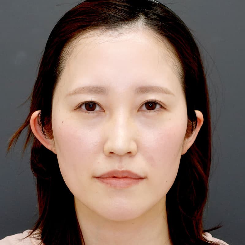 20250831_N133242_tanaka_hyaluronic nose-jaw-eye bags-lips①Before