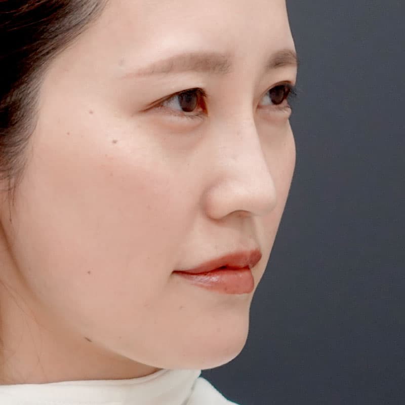 20250831_N133242_tanaka_hyaluronic nose-jaw-eye bags-lips②After
