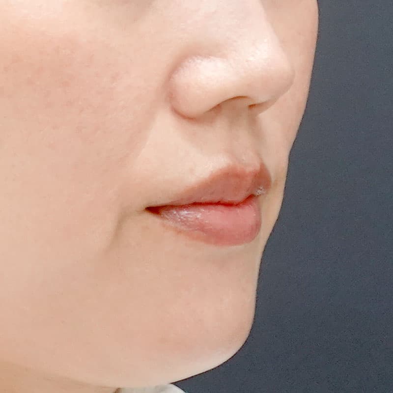 20250831_N48660_tanaka_hyaluronic lips①Before