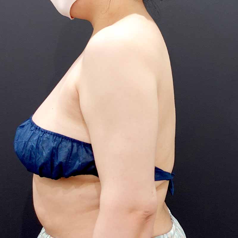 20250801_F2279_kaneko_arm-liposuction①After