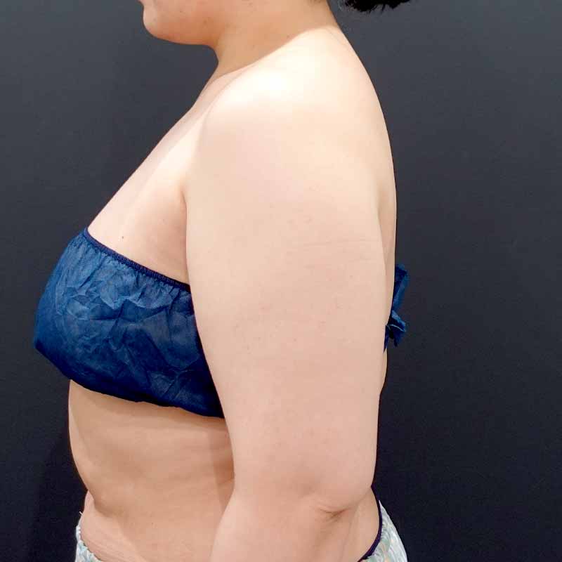 20250801_F2279_kaneko_arm-liposuction①Before