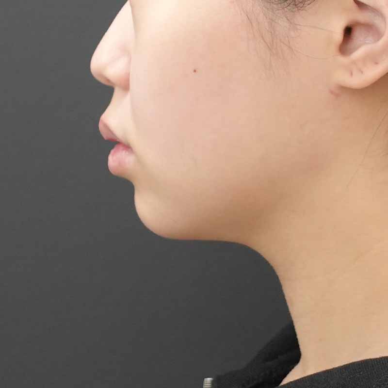 20250801_F3329_kaneko_face-liposuction_masseter-muscle-botox（正面）①After