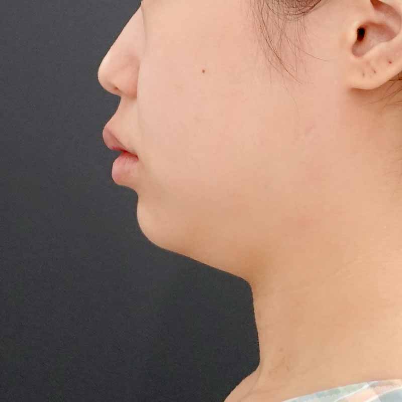 20250801_F3329_kaneko_face-liposuction_masseter-muscle-botox（正面）①Before