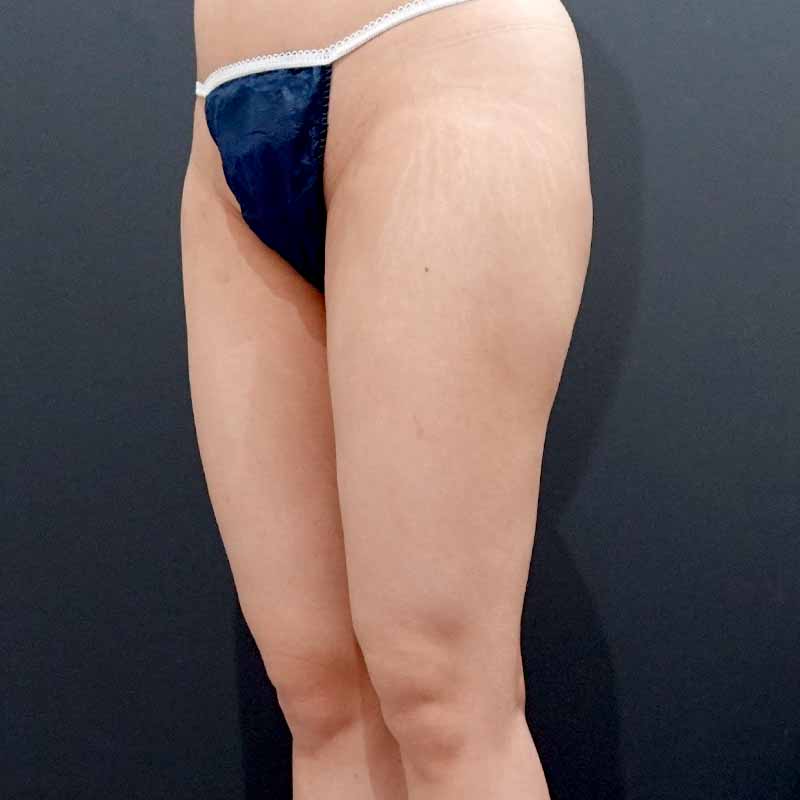 20250801_F4639_kaneko_thigh-liposuction①After