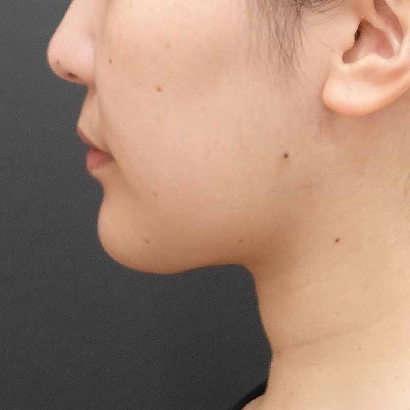 20250801_F4769_kaneko_face-liposuction_masseter-muscle-botox（正面）①After