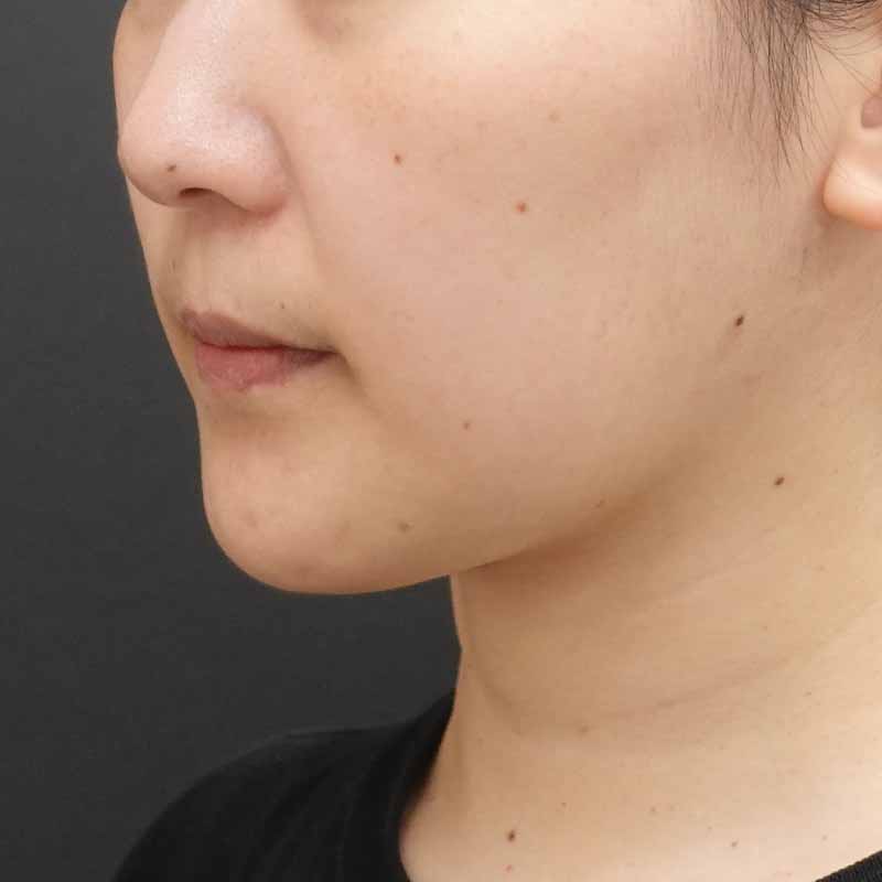 20250801_F4769_kaneko_face-liposuction_masseter-muscle-botox（正面）②After
