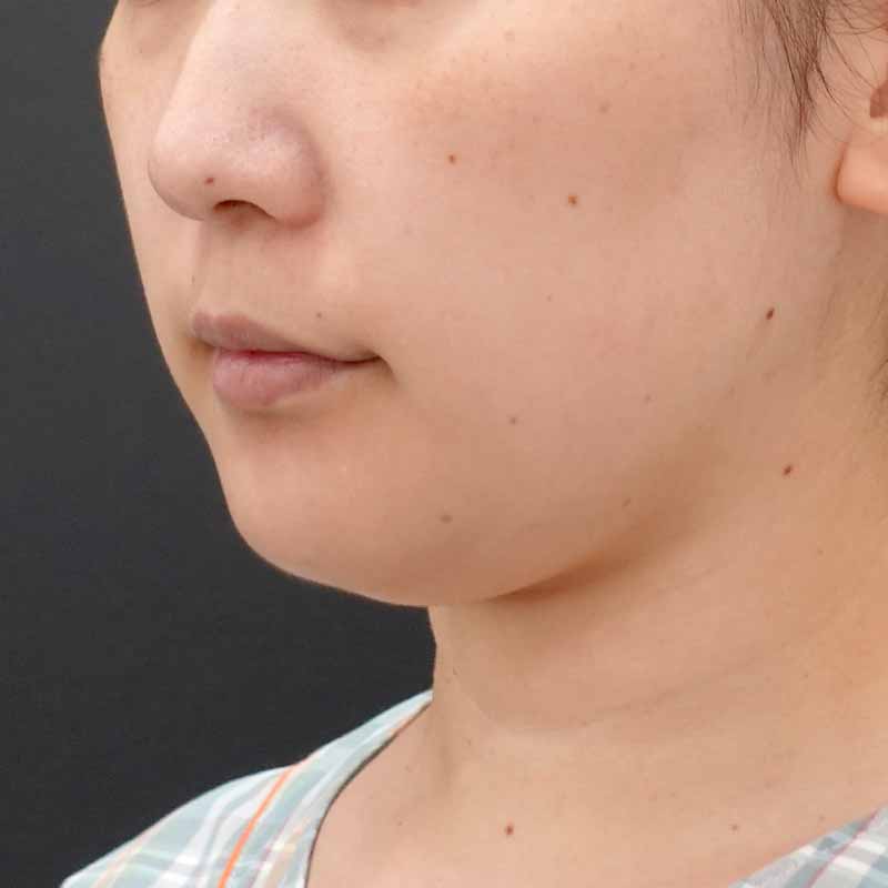 20250801_F4769_kaneko_face-liposuction_masseter-muscle-botox（正面）②Before