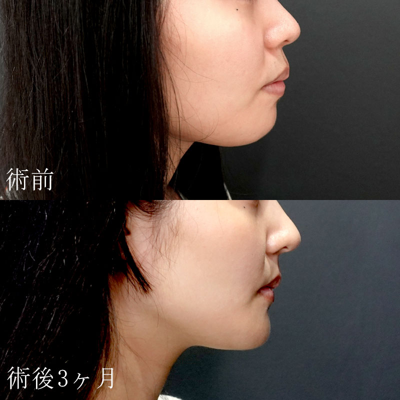 上下顎前歯部歯槽骨切り術(上下セットバック手術)の症例写真(右)