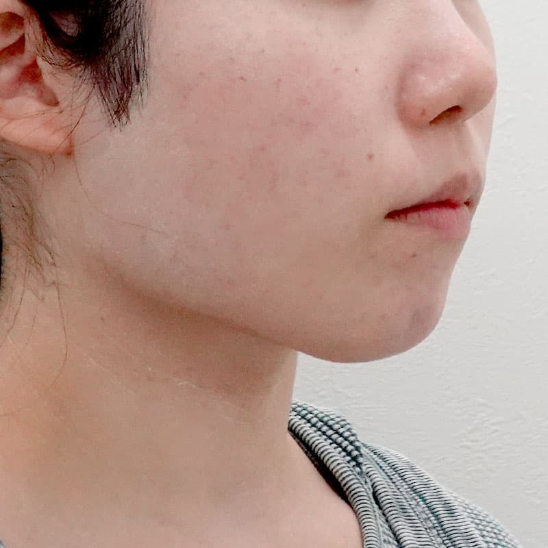 20250910_F117255_nagahama_face-liposuction①After