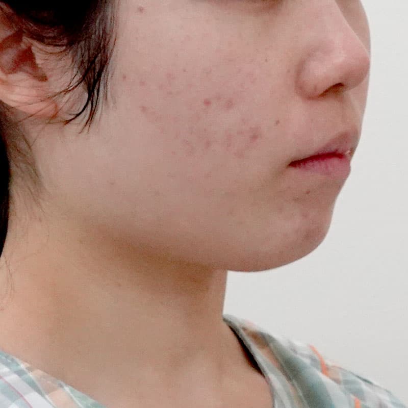 20250910_F117255_nagahama_face-liposuction①Before