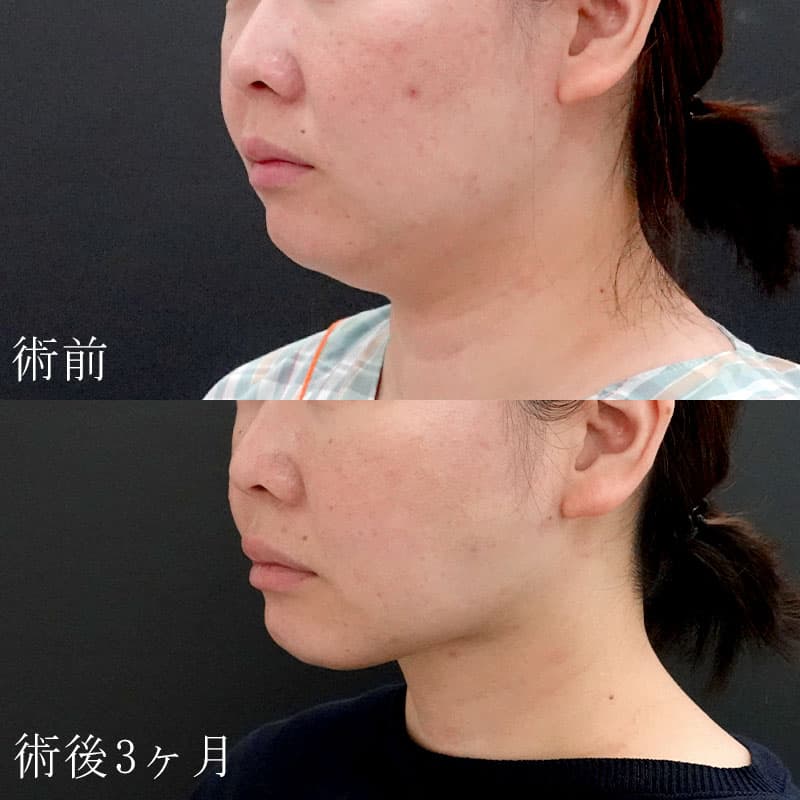 20250910_F7730_nagahama-face-liposuctionメイン横