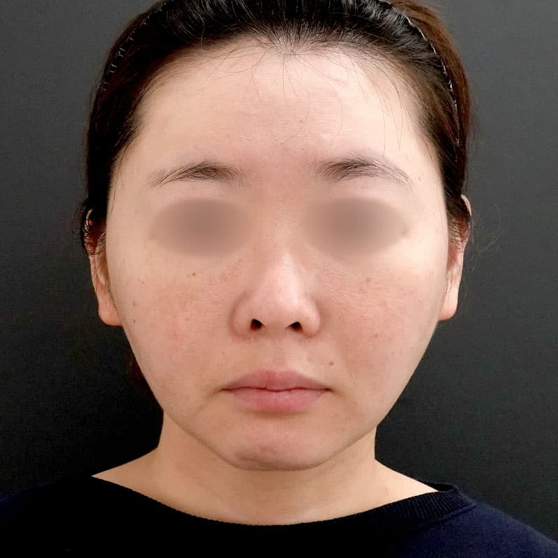 20250910_F7730_nagahama-face-liposuction①After (1)