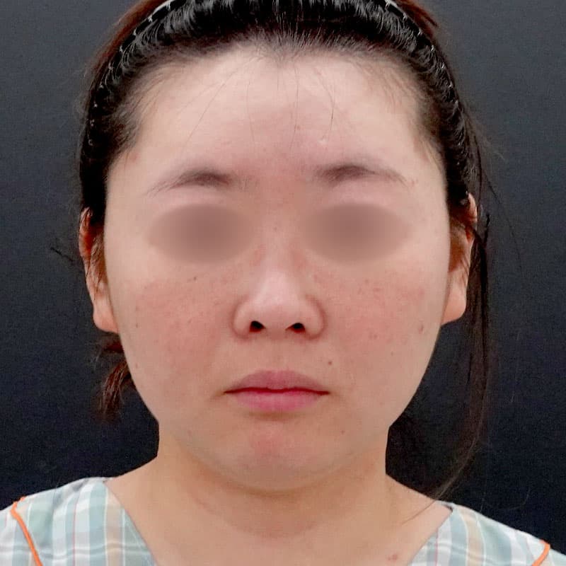 20250910_F7730_nagahama-face-liposuction①Before (1)