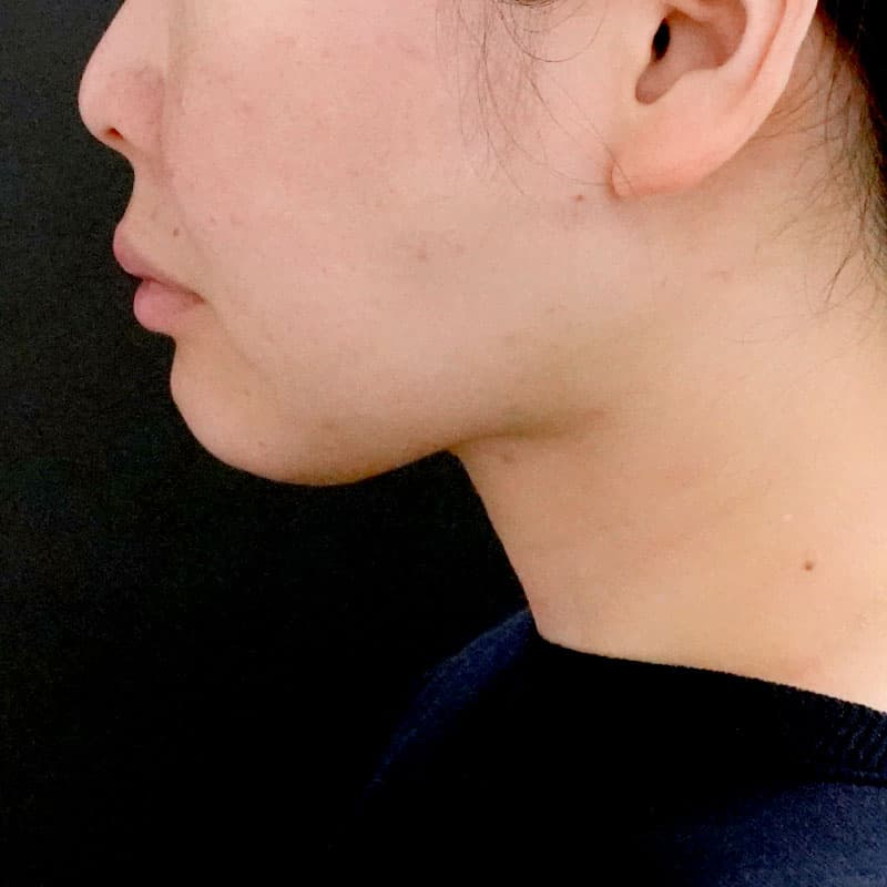 20250910_F7730_nagahama-face-liposuction②After