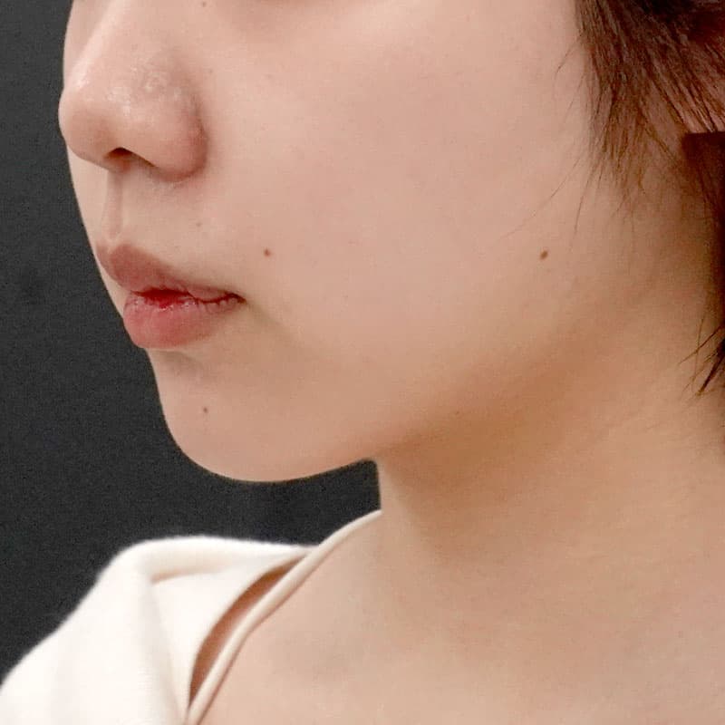 20250910_F7758_nagahama_face-liposuction①After
