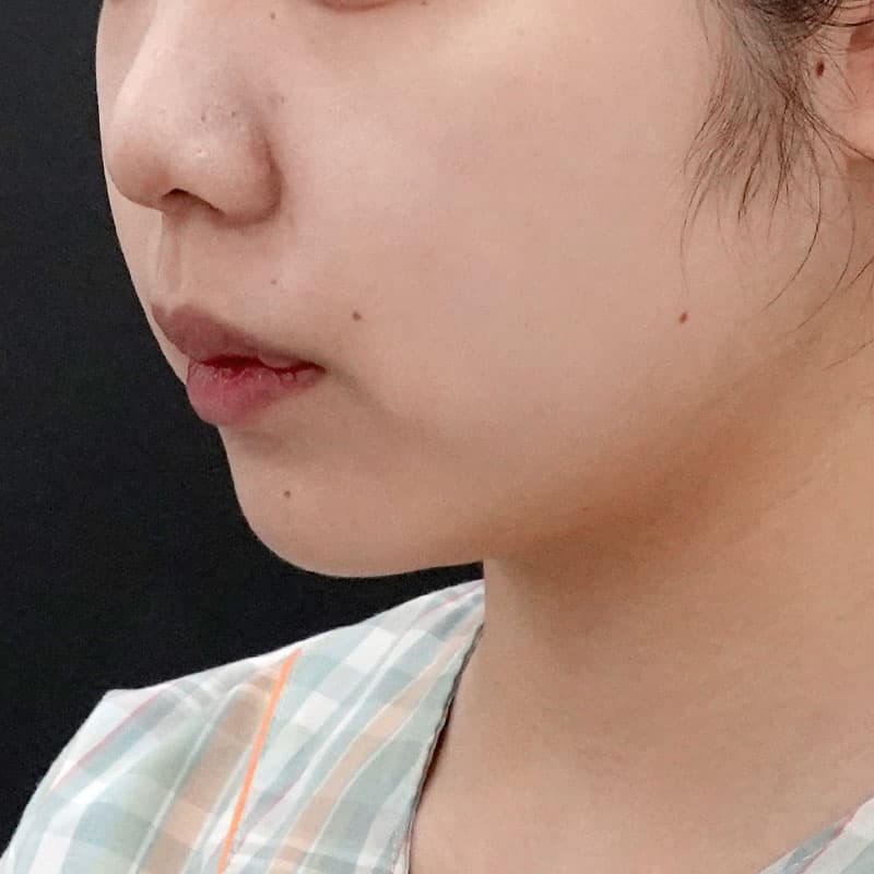 20250910_F7758_nagahama_face-liposuction①Before