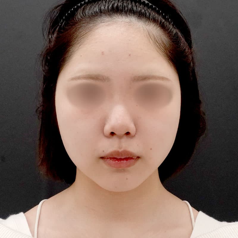 20250910_F7758_nagahama_face-liposuction②After