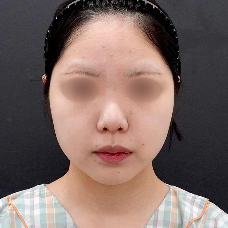 20250910_F7758_nagahama_face-liposuction②Before