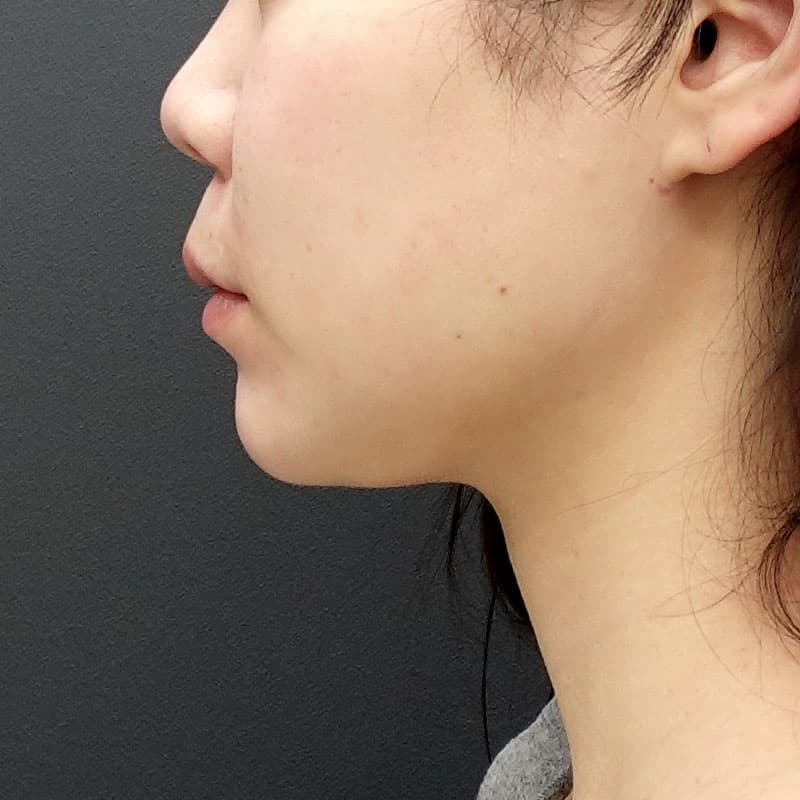 20250910_O114246_nagahama_face-liposuction①After