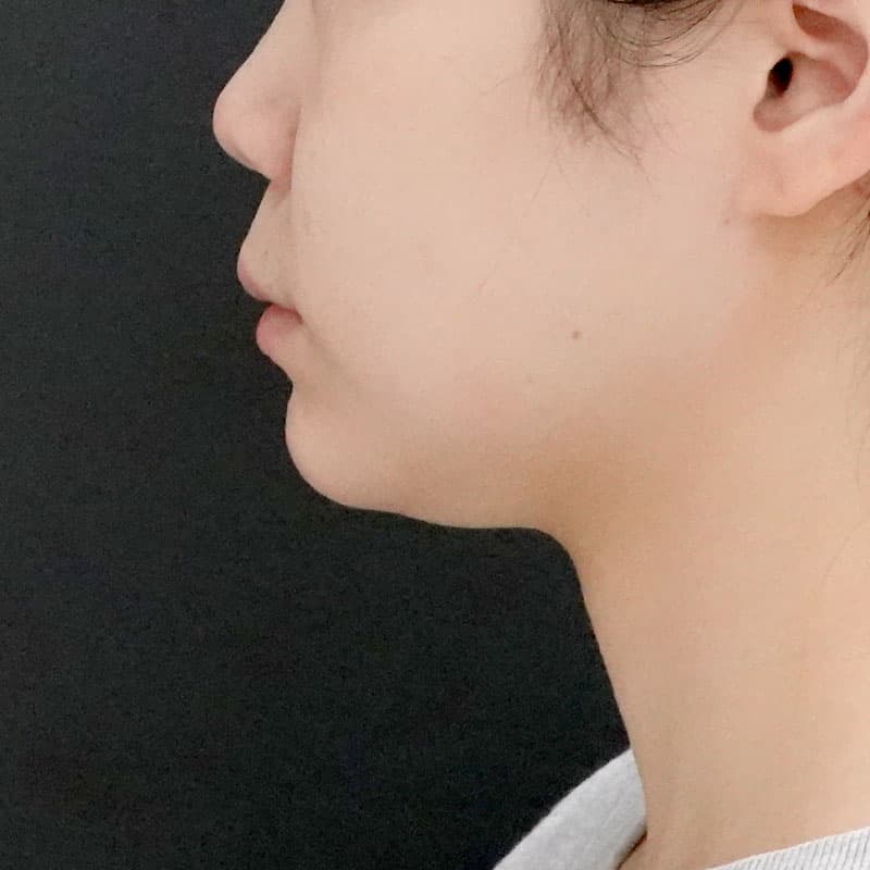 20250910_O114246_nagahama_face-liposuction①Before