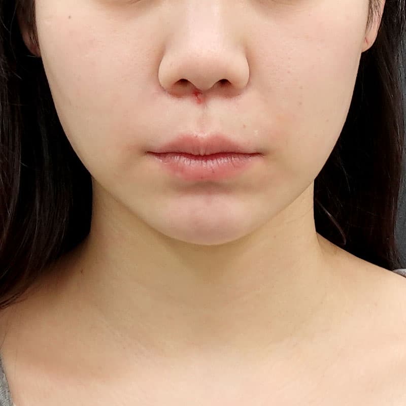 20250910_O114246_nagahama_face-liposuction②After