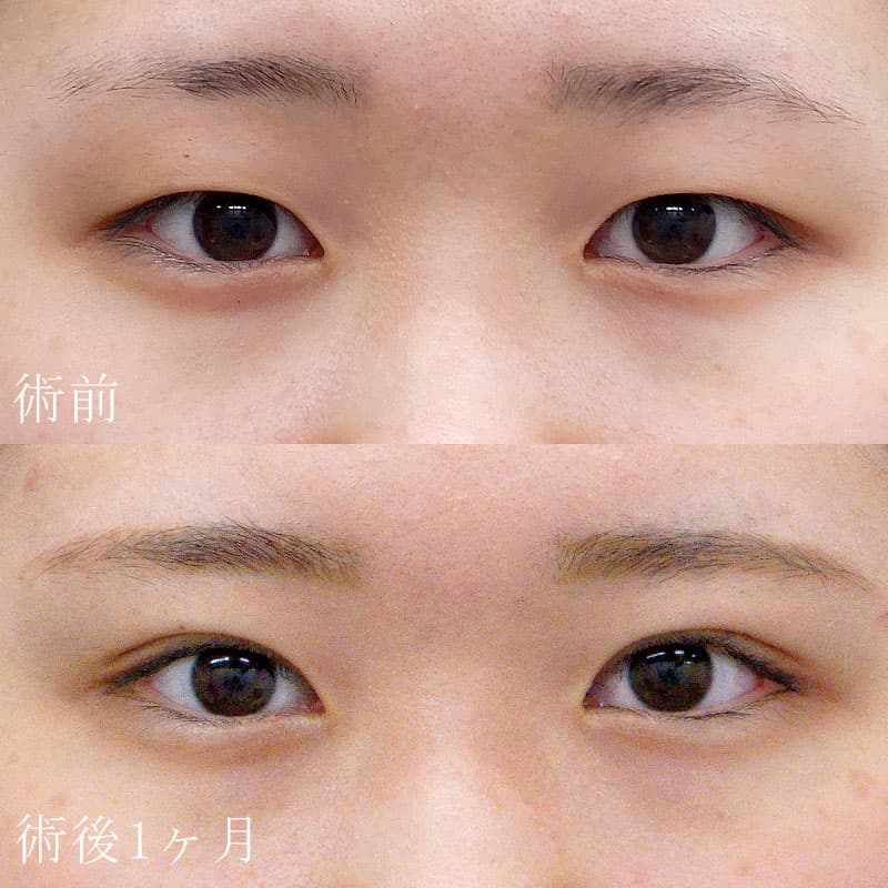 二重埋没法 症例(里 輝幸)