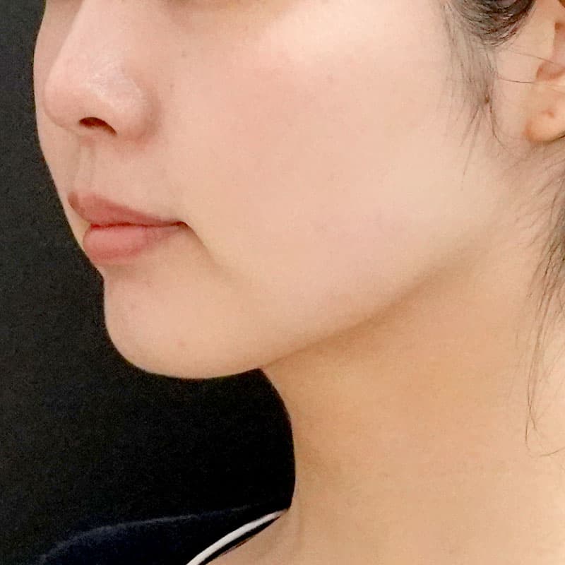 20250910_St20250910-1_nagahama_face-liposuction①After