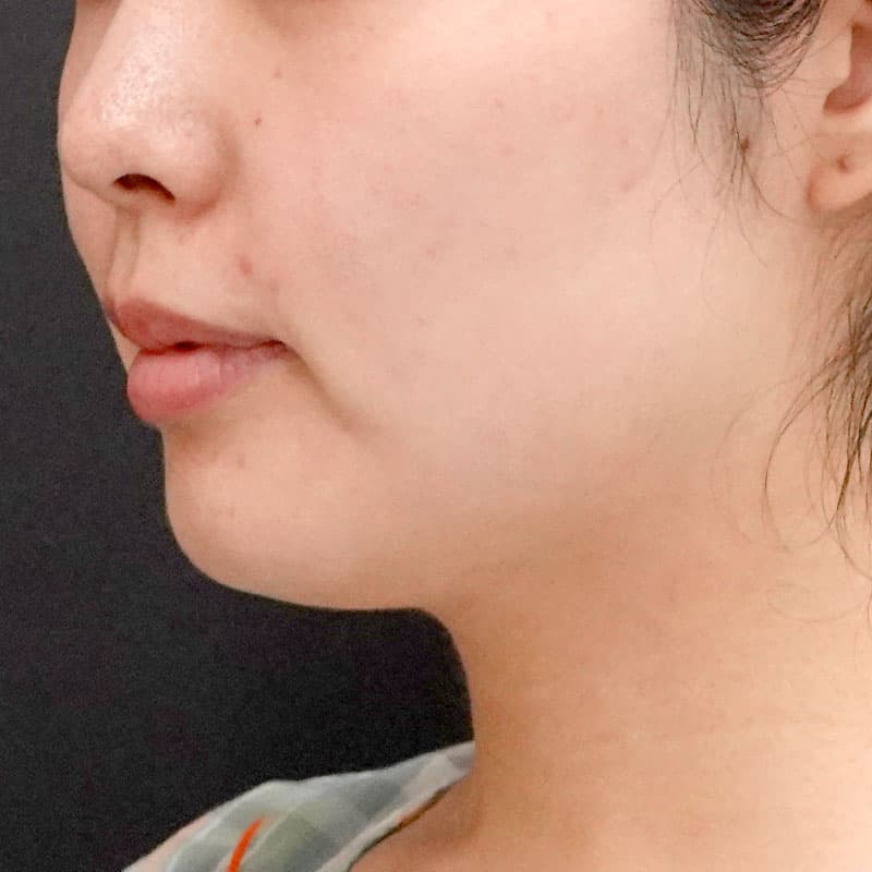 20250910_St20250910-1_nagahama_face-liposuction①Before