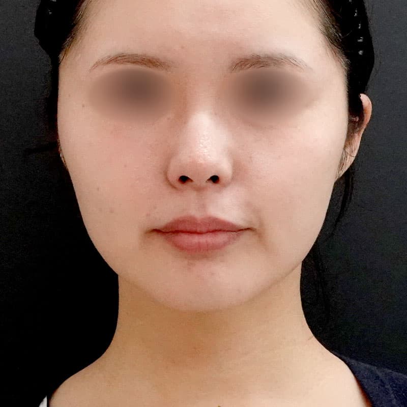 20250910_St20250910-1_nagahama_face-liposuction②After