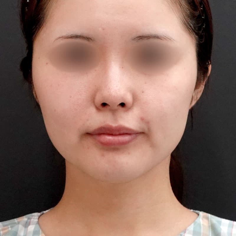 20250910_St20250910-1_nagahama_face-liposuction②Before