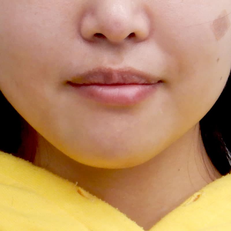 20250913_N16158_nishikawa_hyaluronic forehead-temples- lips①Before