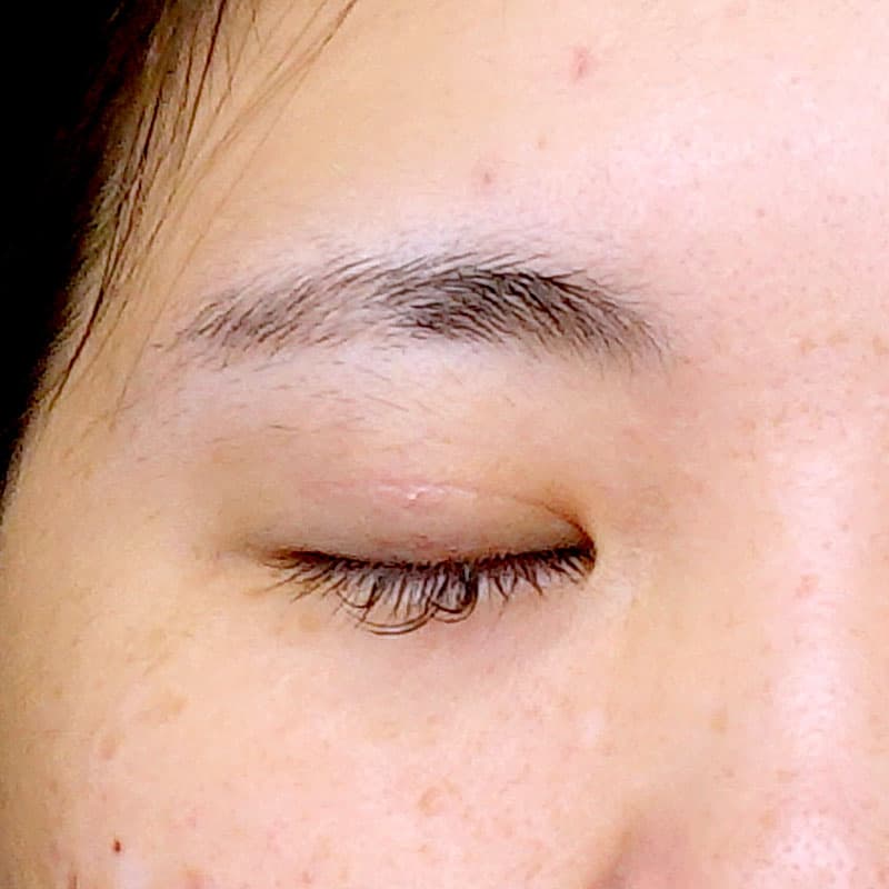 20250920_O24538_sugishima_double-incision-method①After