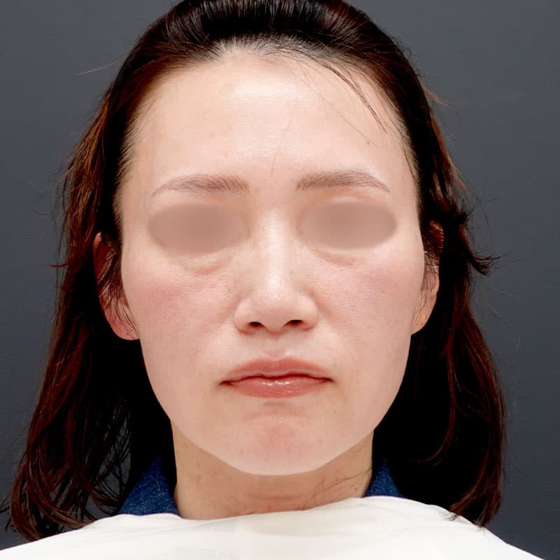 20250928_N133163_tanaka_hyaluronic acid lift①Before