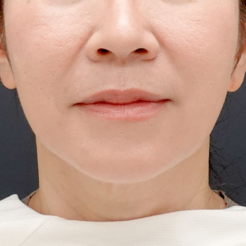 20250928_N39347_tanaka_hyaluronic acid lift①Before