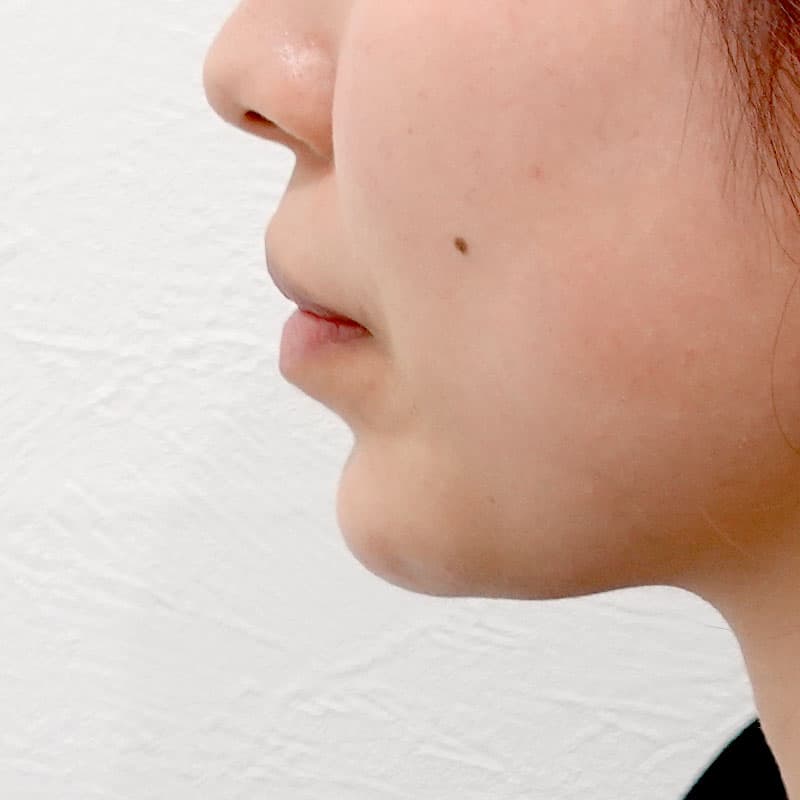 20251011_G143315_sugiyama_hyaluronic jaw①After
