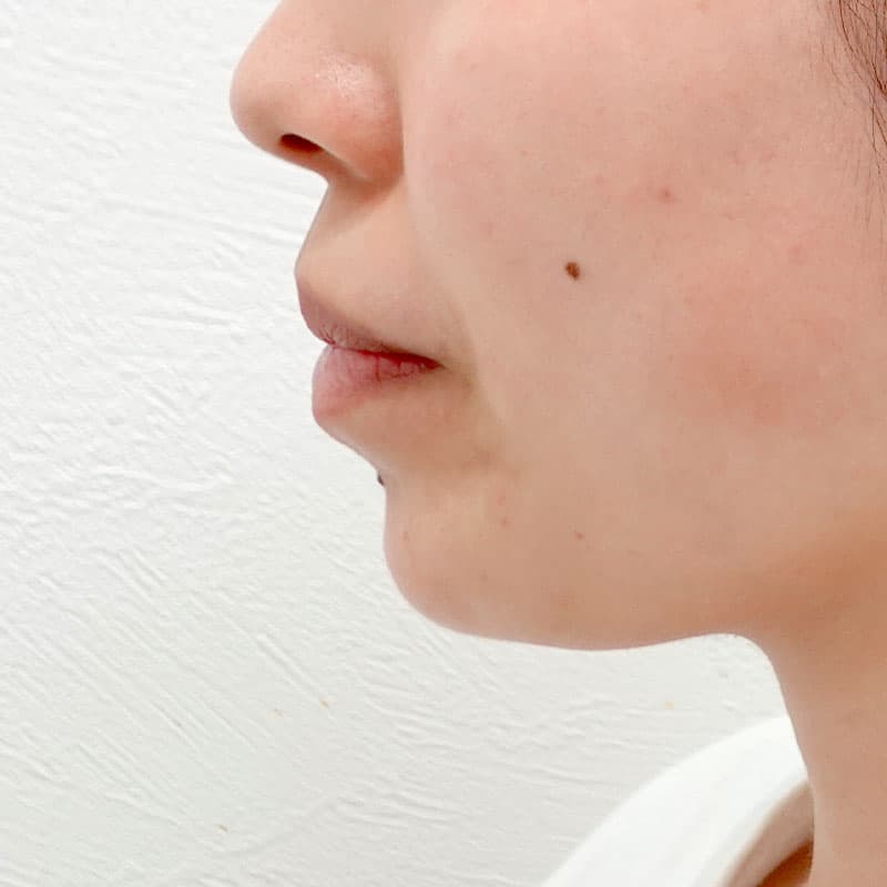 20251011_G143315_sugiyama_hyaluronic jaw①Before