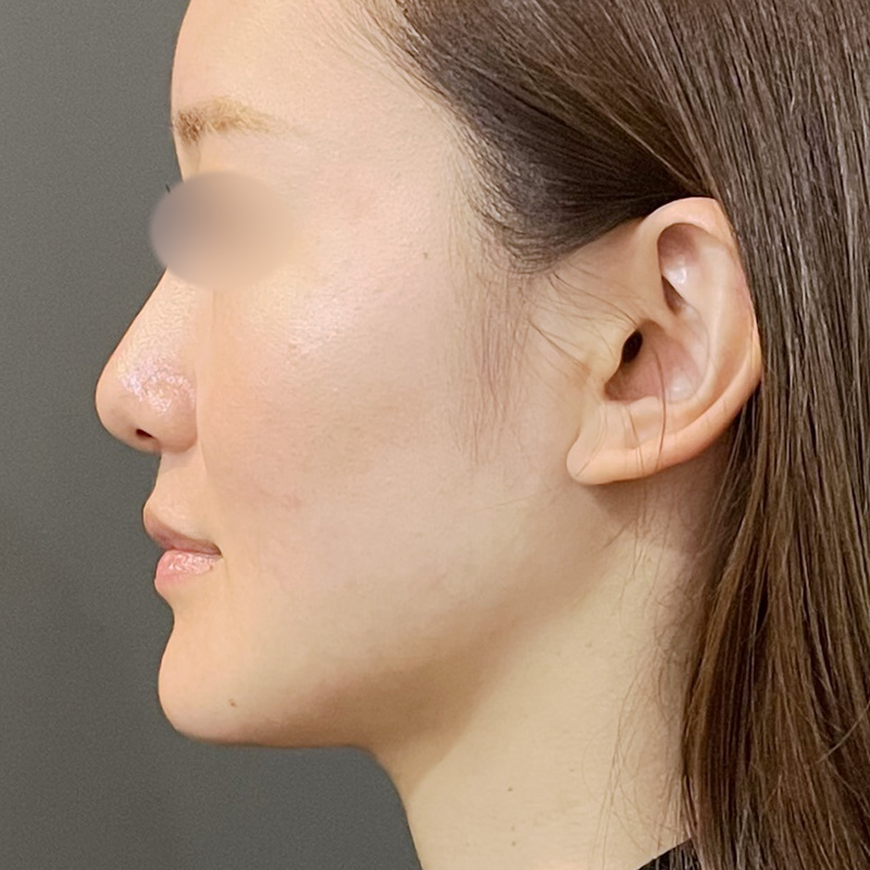 20250910_St20250910_volnewmer After①