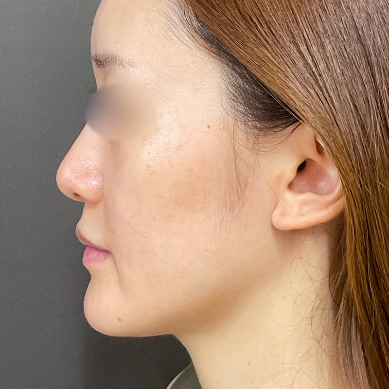 20250910_St20250910_volnewmer Before①