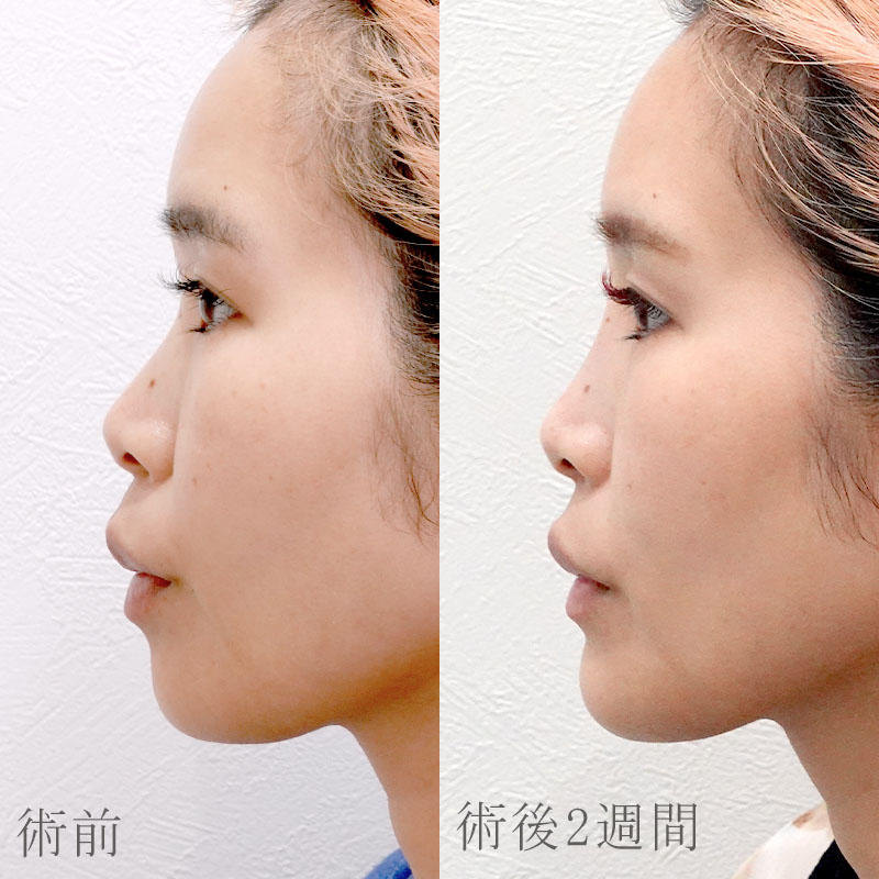 20251003_G143349_sugishima_hyaluronic jawメイン縦