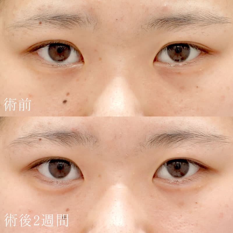 20251006_N139264_hosono_hyaluronic eye bagsメイン横
