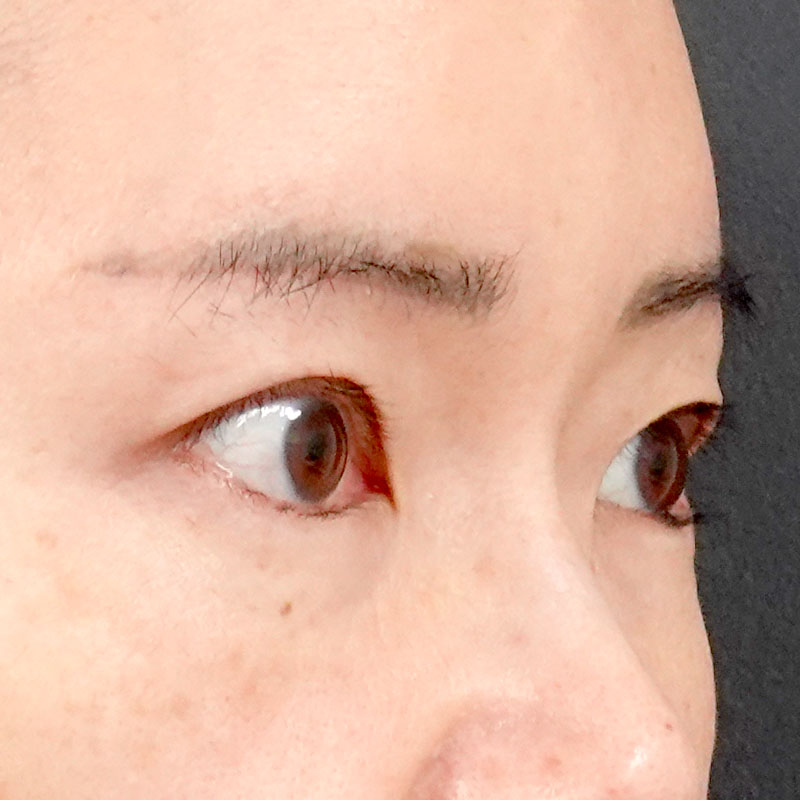 20251011_G126401_ota_under-eyebrow incision①After