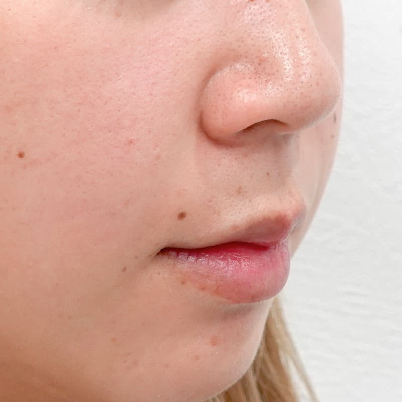 20251011_G143136_tokiwa_hyaluronic lips-nasolabial folds①After