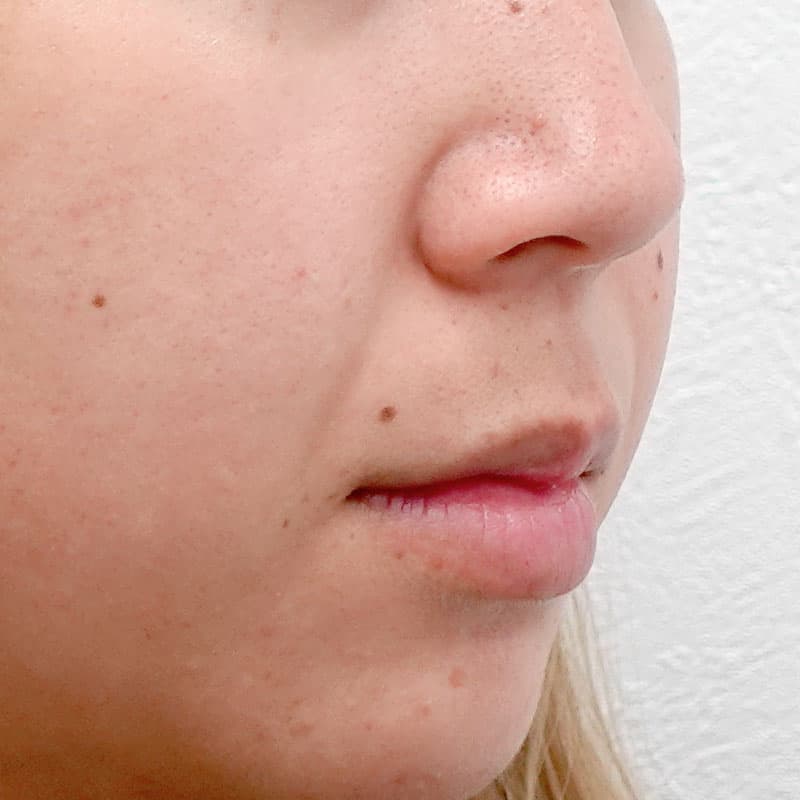 20251011_G143136_tokiwa_hyaluronic lips-nasolabial folds①Before