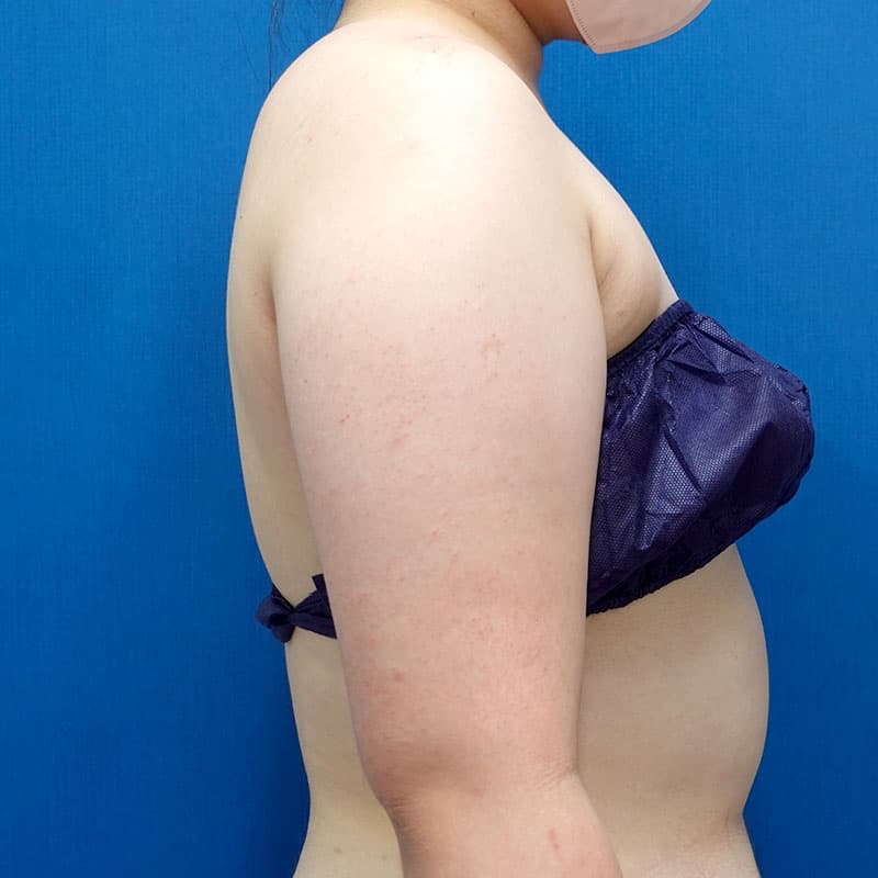 20251011_S18715_hurumura_arm-liposuction①Before