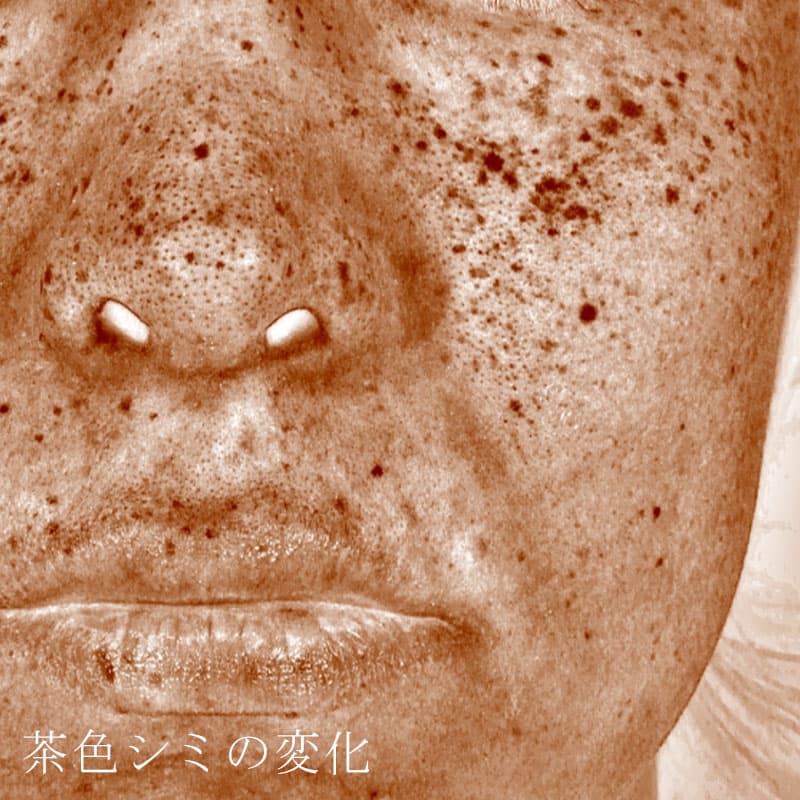 20251013_G31825_mayuko_picolaser①Before